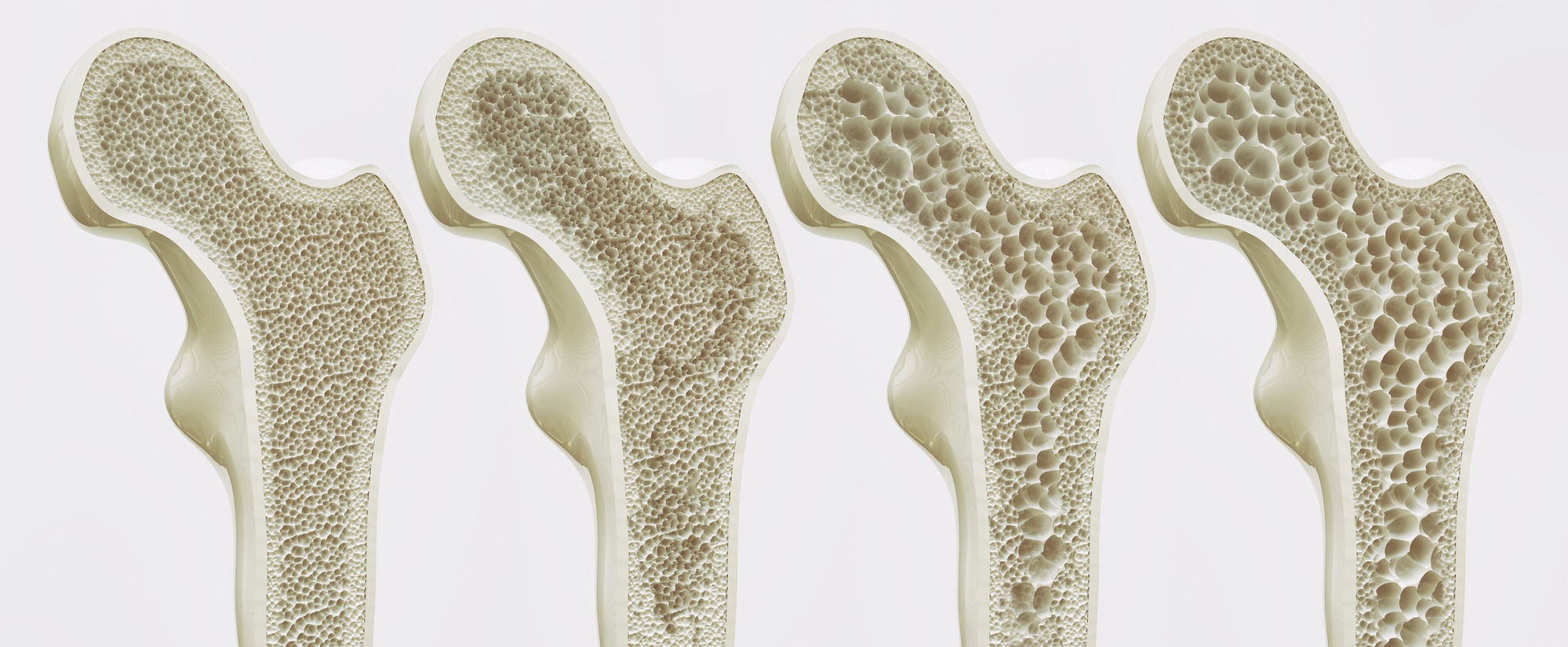 3D rendering of healthy bone density and osteoporosis